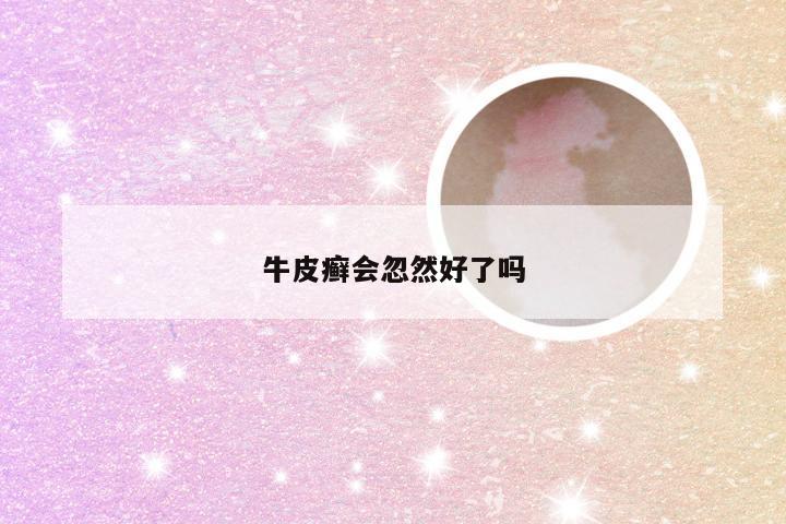 牛皮癣会忽然好了吗