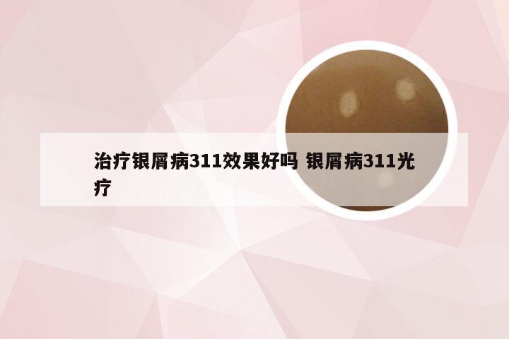 治疗银屑病311效果好吗 银屑病311光疗