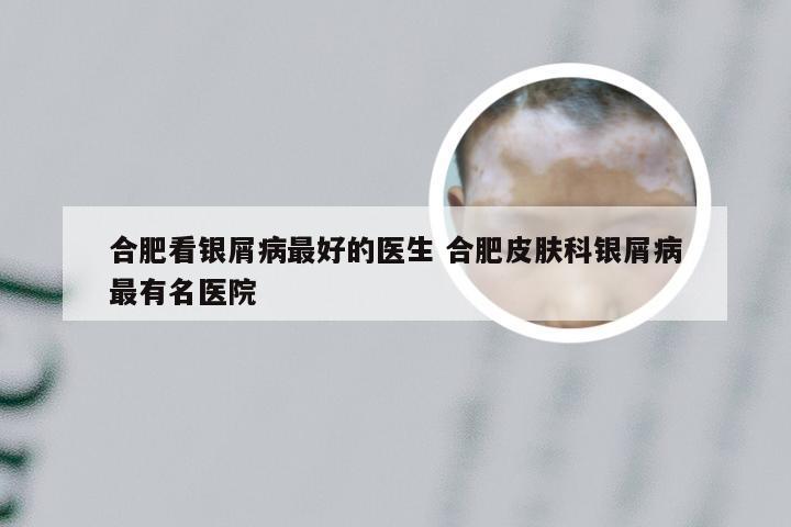 合肥看银屑病最好的医生 合肥皮肤科银屑病最有名医院