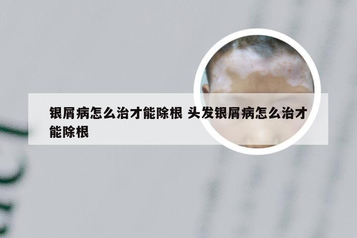银屑病怎么治才能除根 头发银屑病怎么治才能除根