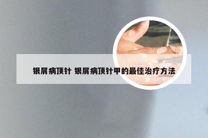 银屑病顶针 银屑病顶针甲的最佳治疗方法