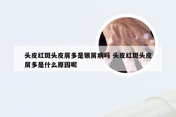 头皮红斑头皮屑多是银屑病吗 头皮红斑头皮屑多是什么原因呢