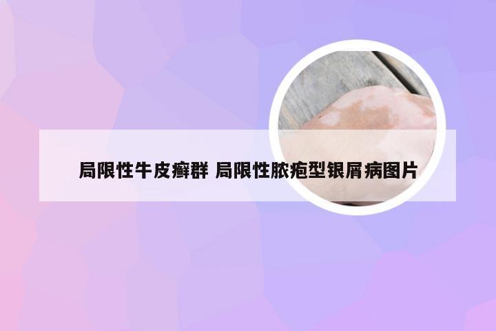 局限性牛皮癣群 局限性脓疱型银屑病图片