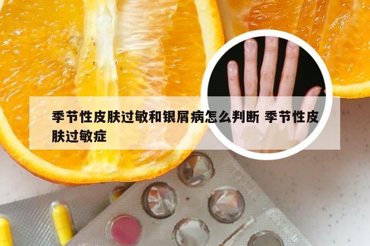 季节性皮肤过敏和银屑病怎么判断 季节性皮肤过敏症