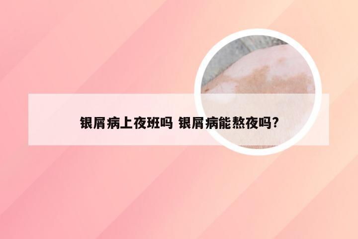 银屑病上夜班吗 银屑病能熬夜吗?