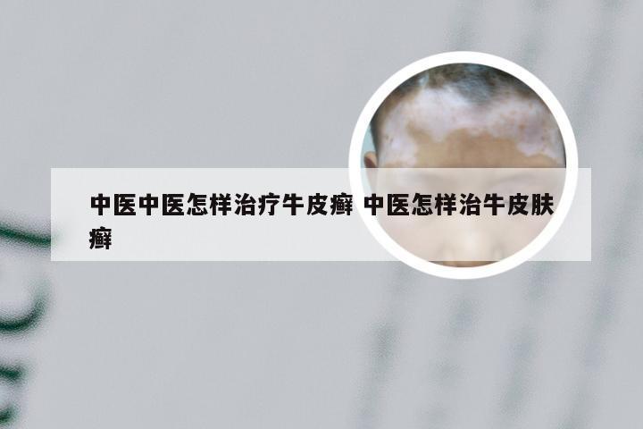 中医中医怎样治疗牛皮癣 中医怎样治牛皮肤癣