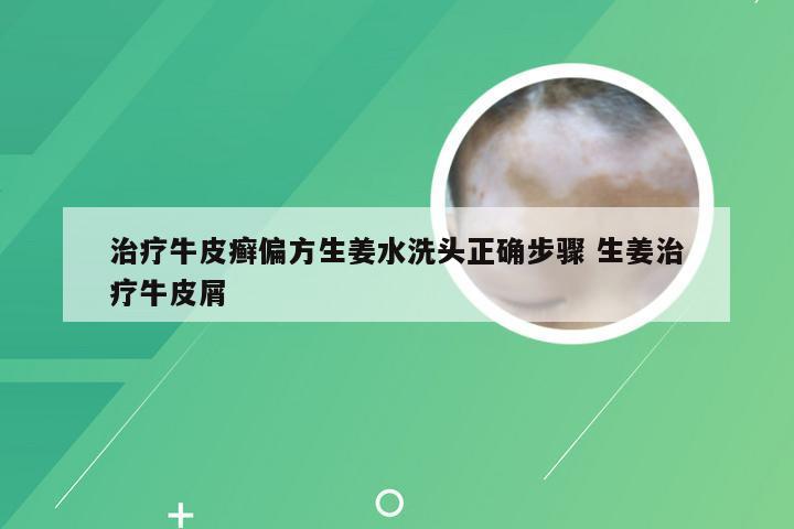 治疗牛皮癣偏方生姜水洗头正确步骤 生姜治疗牛皮屑