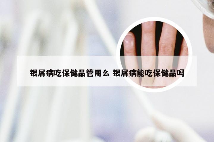 银屑病吃保健品管用么 银屑病能吃保健品吗