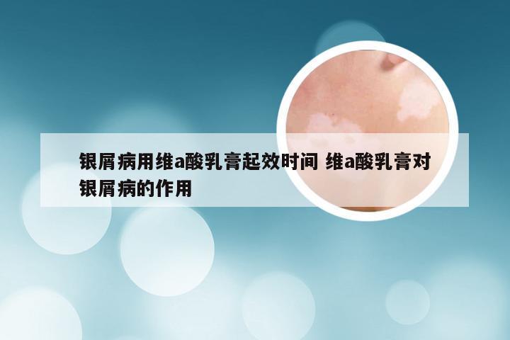 银屑病用维a酸乳膏起效时间 维a酸乳膏对银屑病的作用