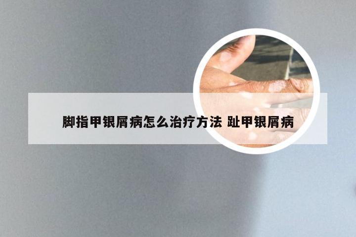 脚指甲银屑病怎么治疗方法 趾甲银屑病