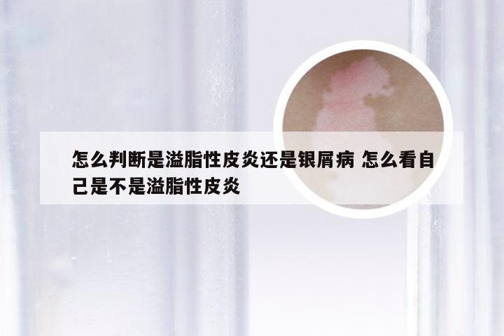 怎么判断是溢脂性皮炎还是银屑病 怎么看自己是不是溢脂性皮炎