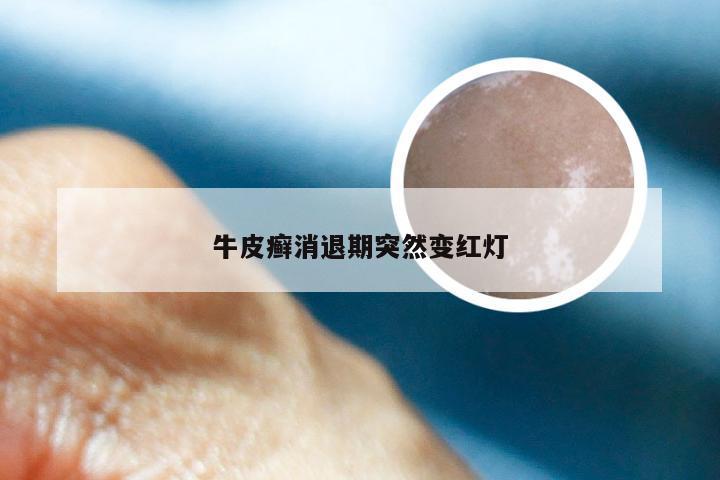 牛皮癣消退期突然变红灯