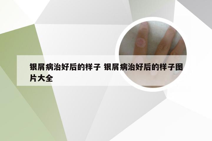 银屑病治好后的样子 银屑病治好后的样子图片大全