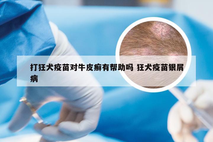打狂犬疫苗对牛皮癣有帮助吗 狂犬疫苗银屑病