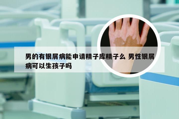 男的有银屑病能申请精子库精子么 男性银屑病可以生孩子吗