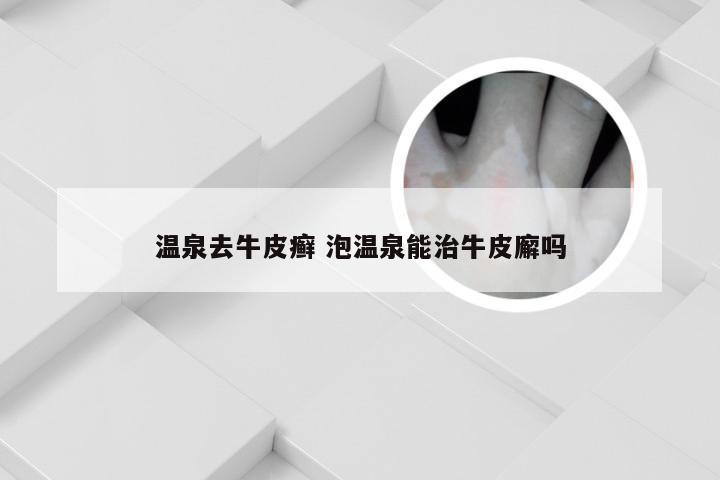 温泉去牛皮癣 泡温泉能治牛皮廨吗