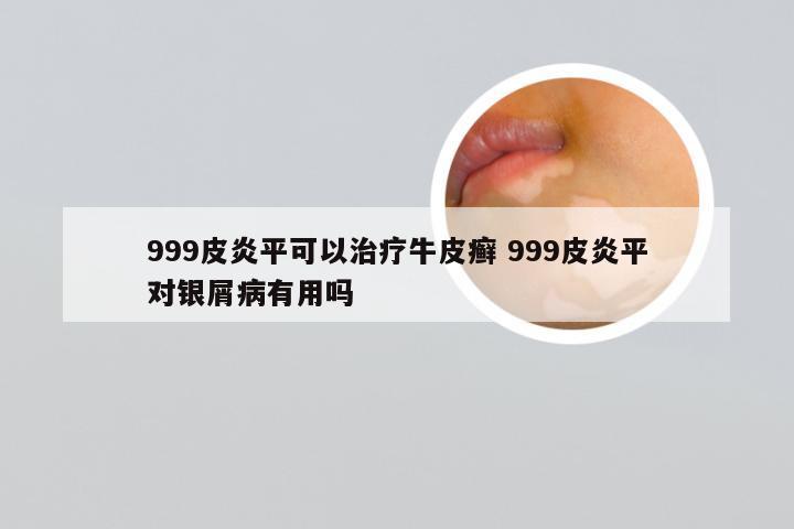 999皮炎平可以治疗牛皮癣 999皮炎平对银屑病有用吗