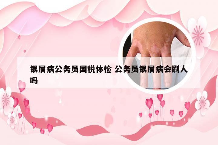 银屑病公务员国税体检 公务员银屑病会刷人吗