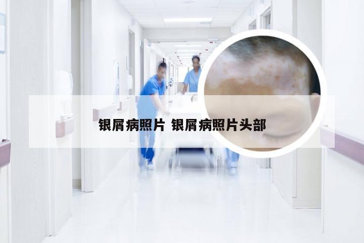 银屑病照片 银屑病照片头部