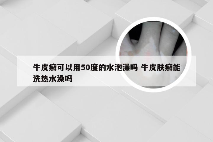 牛皮癣可以用50度的水泡澡吗 牛皮肤癣能洗热水澡吗