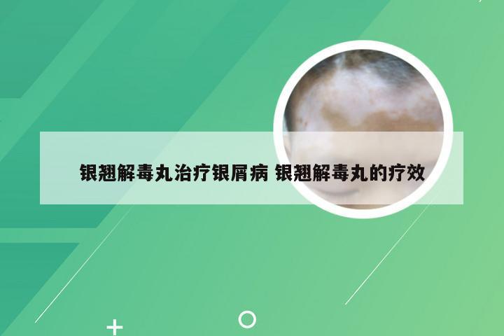 银翘解毒丸治疗银屑病 银翘解毒丸的疗效