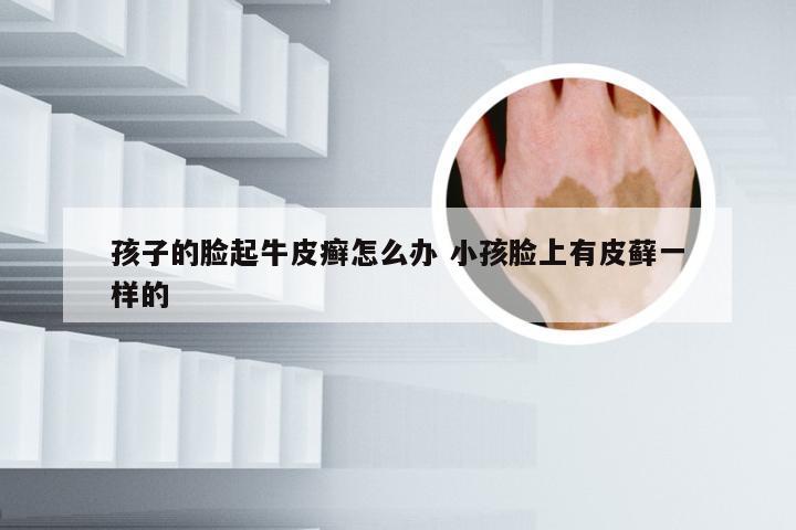 孩子的脸起牛皮癣怎么办 小孩脸上有皮藓一样的