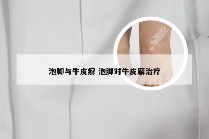 泡脚与牛皮癣 泡脚对牛皮廨治疗