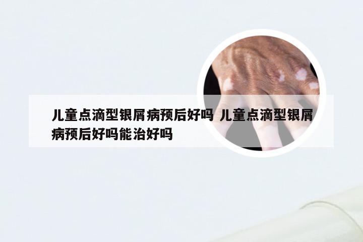 儿童点滴型银屑病预后好吗 儿童点滴型银屑病预后好吗能治好吗