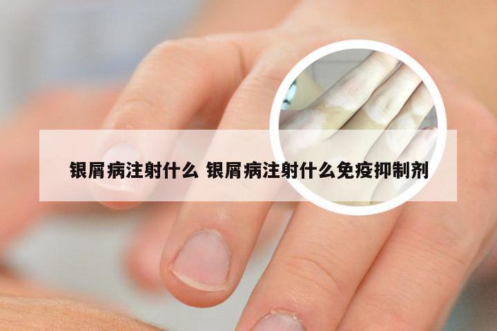 银屑病注射什么 银屑病注射什么免疫抑制剂