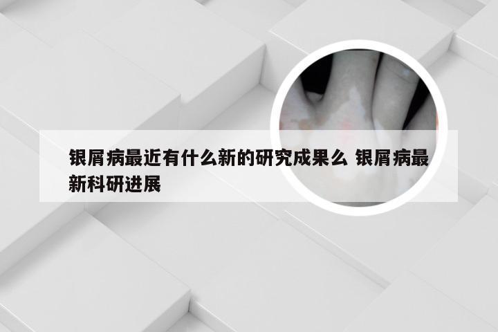 银屑病最近有什么新的研究成果么 银屑病最新科研进展