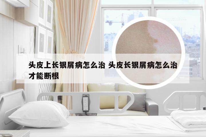 头皮上长银屑病怎么治 头皮长银屑病怎么治才能断根
