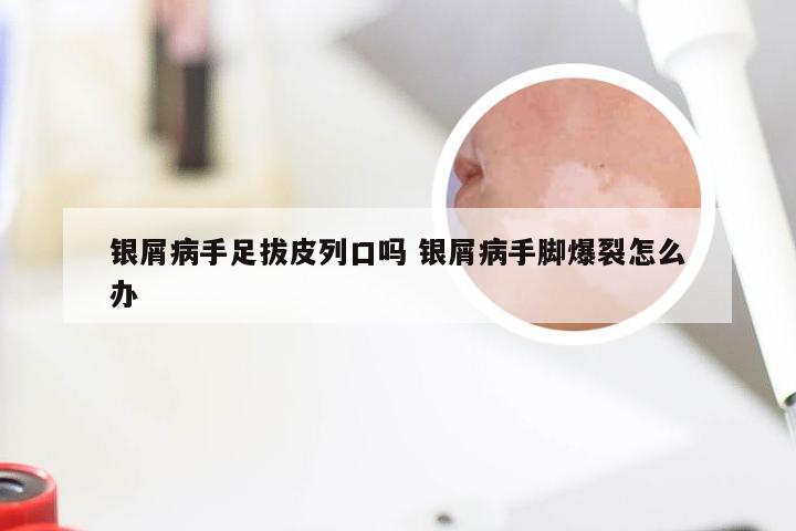 银屑病手足拔皮列口吗 银屑病手脚爆裂怎么办