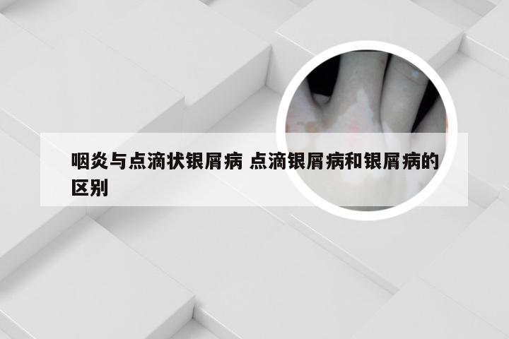 咽炎与点滴状银屑病 点滴银屑病和银屑病的区别