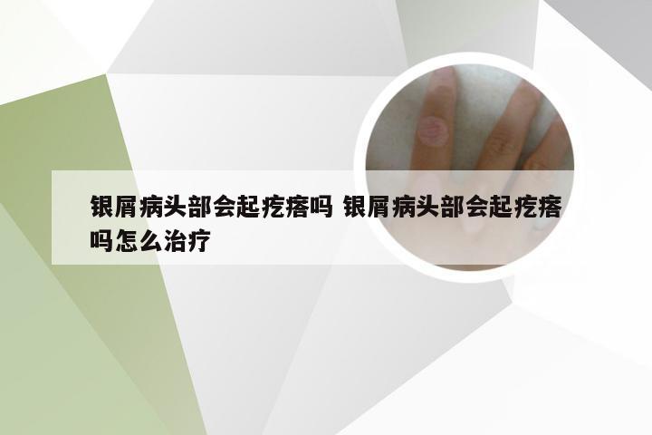 银屑病头部会起疙瘩吗 银屑病头部会起疙瘩吗怎么治疗