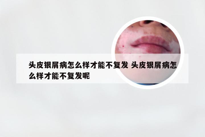头皮银屑病怎么样才能不复发 头皮银屑病怎么样才能不复发呢