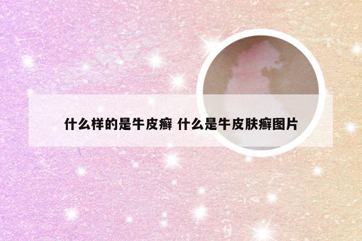 什么样的是牛皮癣 什么是牛皮肤癣图片