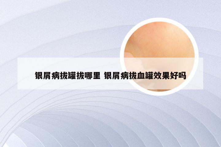 银屑病拔罐拔哪里 银屑病拔血罐效果好吗