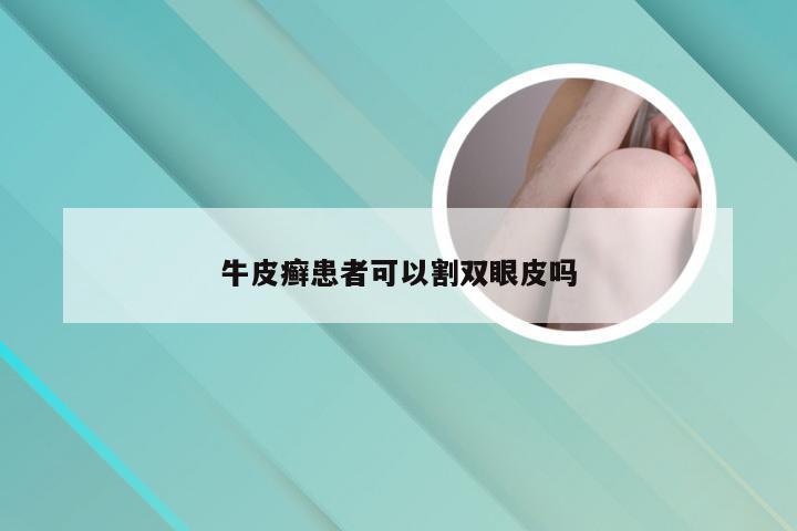 牛皮癣患者可以割双眼皮吗