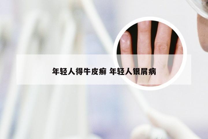 年轻人得牛皮癣 年轻人银屑病
