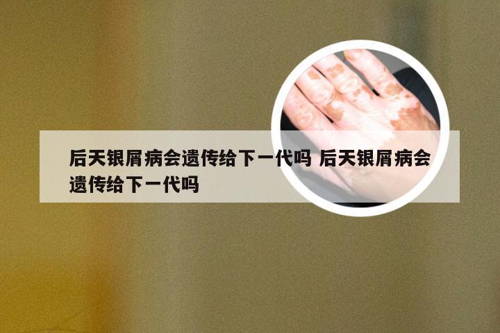 后天银屑病会遗传给下一代吗 后天银屑病会遗传给下一代吗