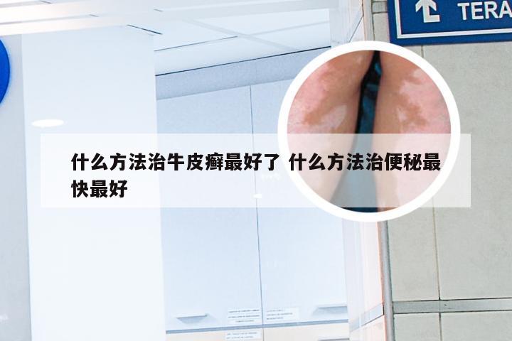 什么方法治牛皮癣最好了 什么方法治便秘最快最好