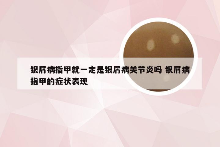 银屑病指甲就一定是银屑病关节炎吗 银屑病指甲的症状表现
