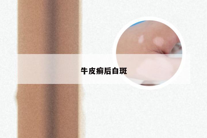 牛皮癣后白斑