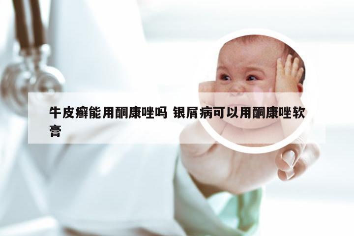 牛皮癣能用酮康唑吗 银屑病可以用酮康唑软膏