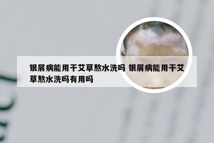 银屑病能用干艾草熬水洗吗 银屑病能用干艾草熬水洗吗有用吗