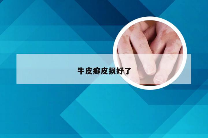 牛皮癣皮损好了