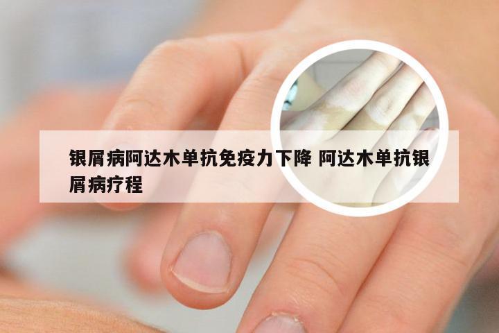 银屑病阿达木单抗免疫力下降 阿达木单抗银屑病疗程