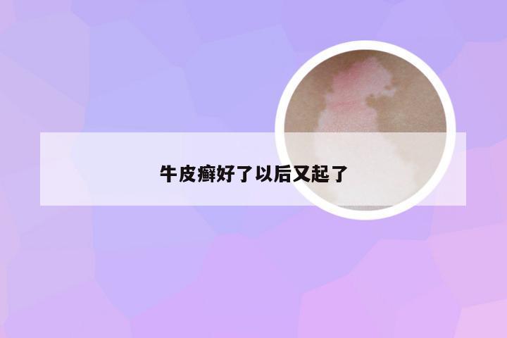 牛皮癣好了以后又起了