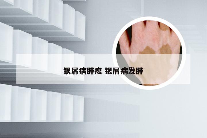 银屑病胖瘦 银屑病发胖