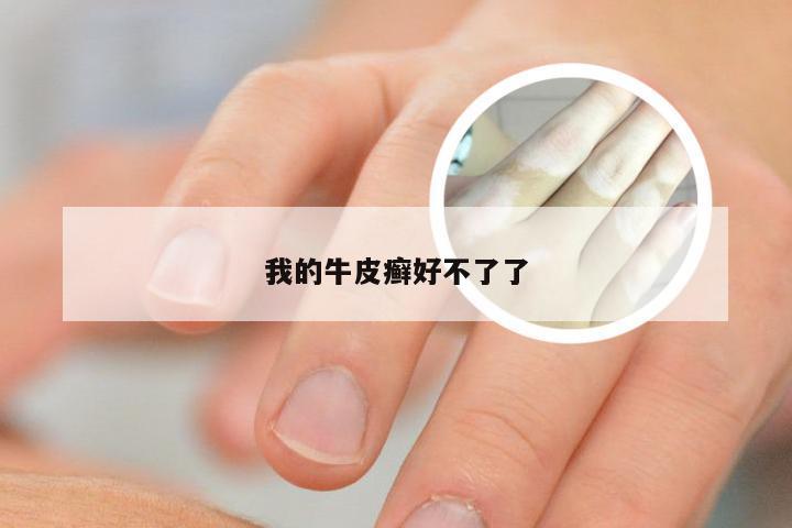 我的牛皮癣好不了了